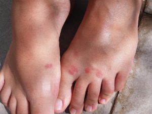 mosquito bite